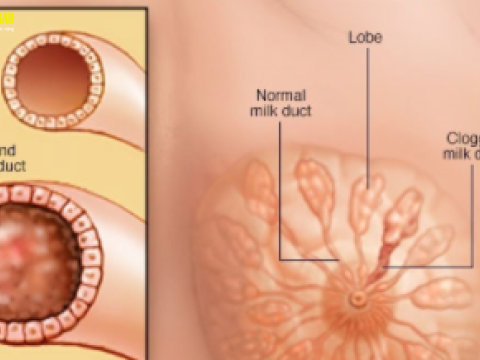 Điều trị viêm tắc tia sữa