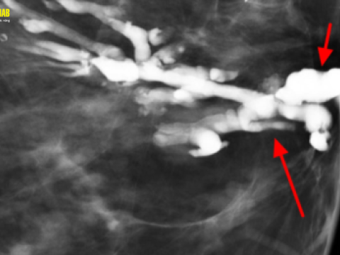 Điều trị viêm tắc tia sữa