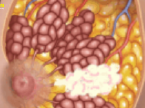 Điều trị viêm tắc tia sữa