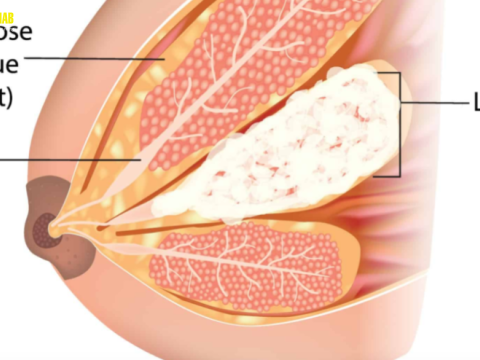 Điều trị viêm tắc tia sữa