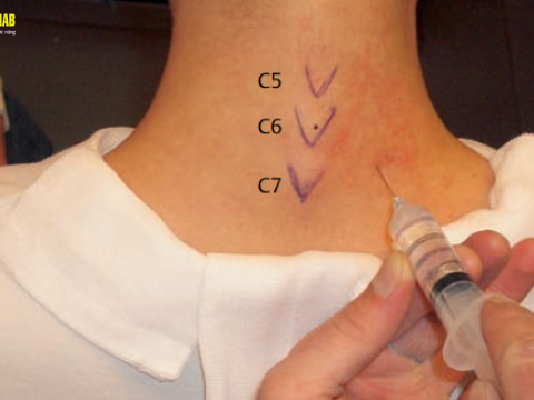 Tiêm cột sống